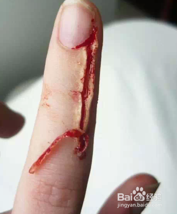 指甲周围长倒刺，一招就能轻松解决