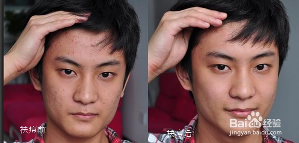 如何祛痘痘小编教你