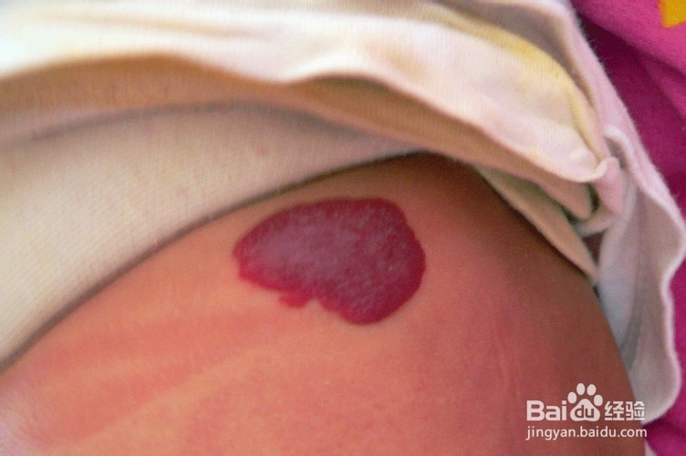 脂肪肝及常见的肝病预防