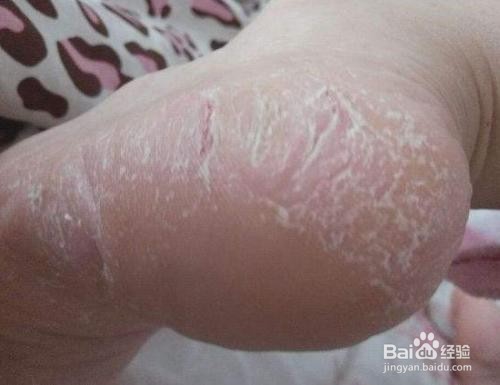 手脚容易裂口有什么办法能解决?