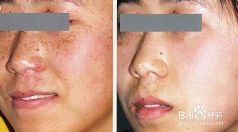本人中药 祛斑 经验 效果 超好
