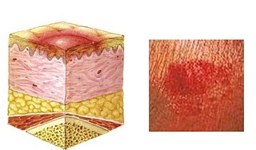 压疮的治疗方法
