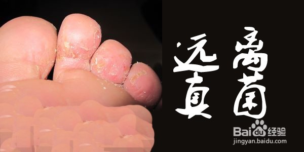 应该怎么预防脚气