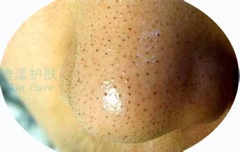 鼻子上的黑头怎么去掉 去黑头的七种小秘密