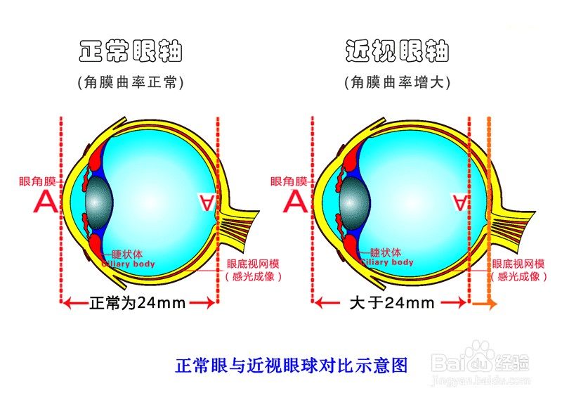 近视该如何治疗（近视的原理及治疗方法）