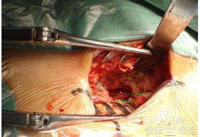 解决椎间盘突出症状的三个要点及误区