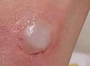 被爆炸的氢气球炸伤了怎么办