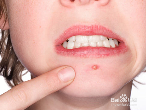 皮肤科医生揭示痤疮的主要原因