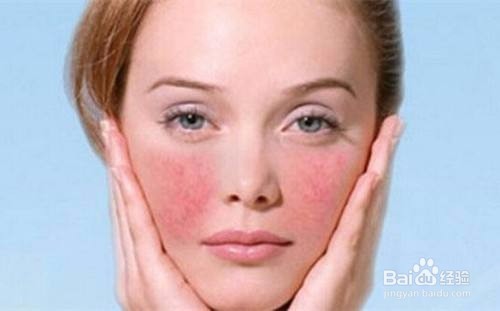 脸部敏感甚至还有红血丝是怎么回事？