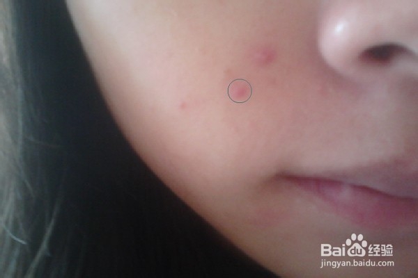 如何用PS去除脸上的痘痘