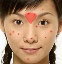 脸部痘痘辨别自己的身体信号！
