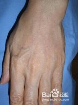 老年人“青筋”凸起什么缘故呢