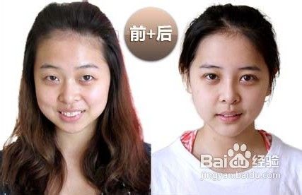 韩式无痕开眼角效果好不好