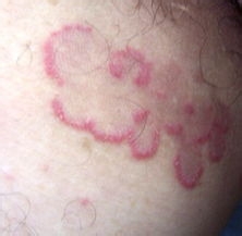 小偏方治疗男性阴囊瘙痒