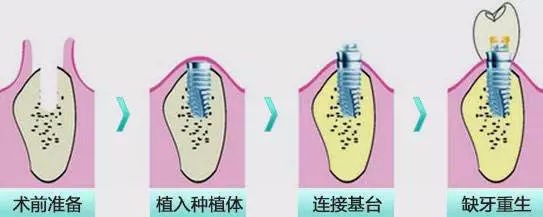 做武汉种植牙需要满足这些条件！