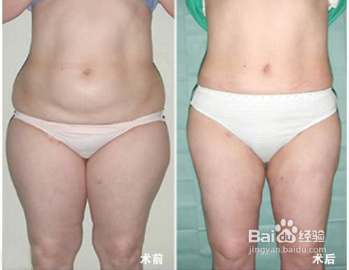 水动力吸脂对比图