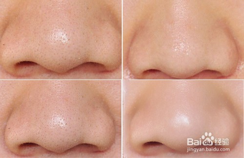 如何更快效果的去除黑头？