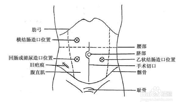 护士执业资格考试:临时性肠造口护理
