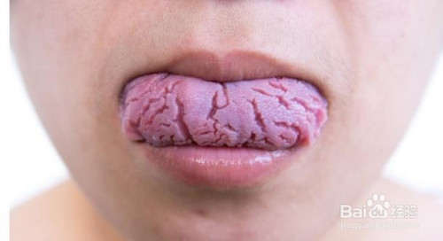 舌裂纹怎么清洁