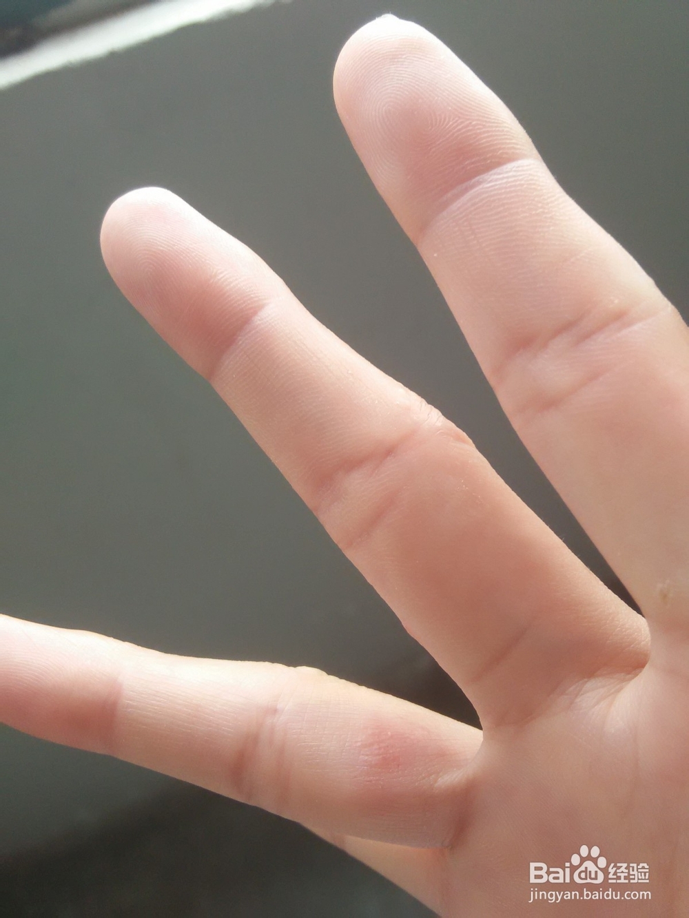 分享手上长水泡如何治愈的方法