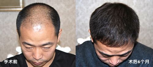 遗传性脱发如何治疗