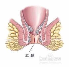 肛裂如何自愈