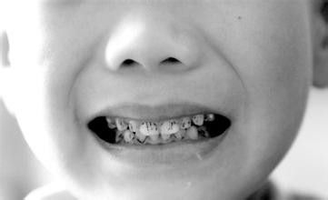 家长如何预防孩子蛀牙