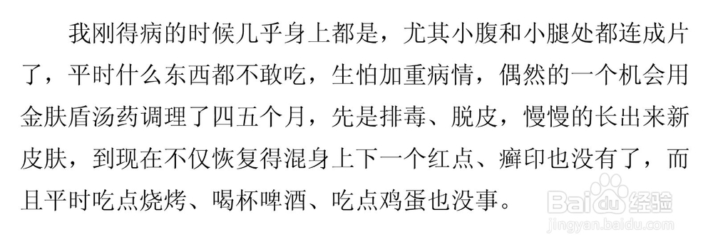 得了牛皮癣能吃鸡蛋吗