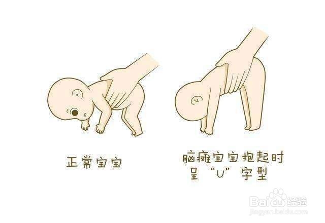 八种异常姿势来快速判断宝宝是否有脑瘫