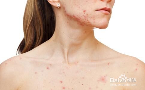 怎么治疗湿疹比较有效