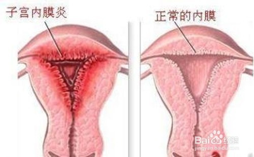 子宫内膜炎有哪些症状