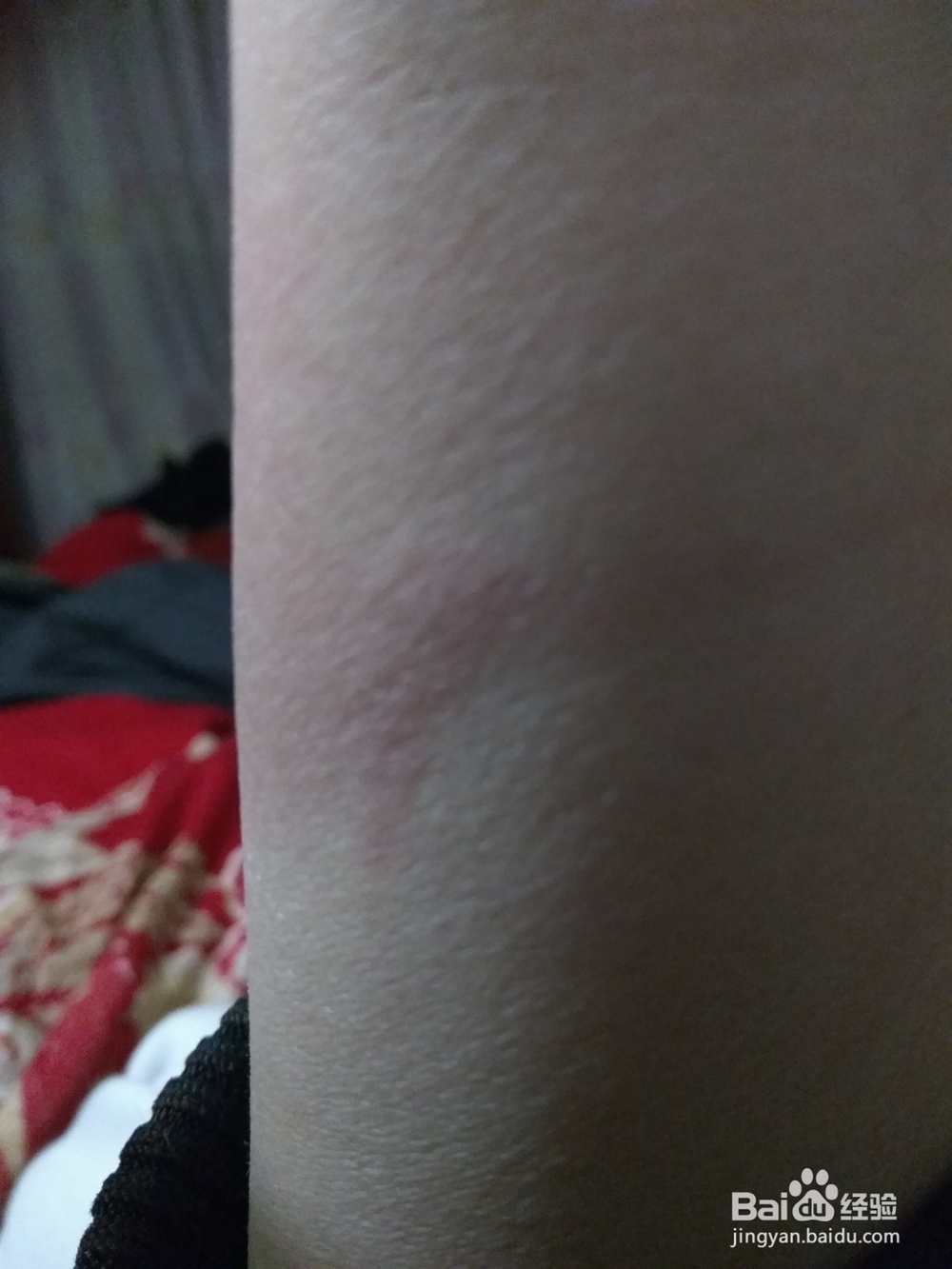 被烫伤的急救办法