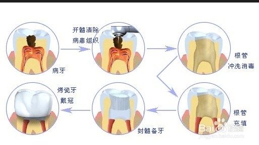 牙齿根管治疗后，为何还痛？