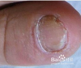 得了灰指甲的危害