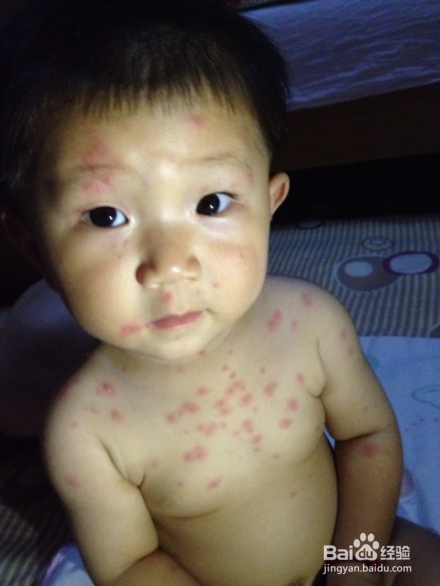 宝宝起水痘的表现