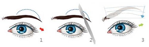 祛眼袋：[4]什么是提眉术
