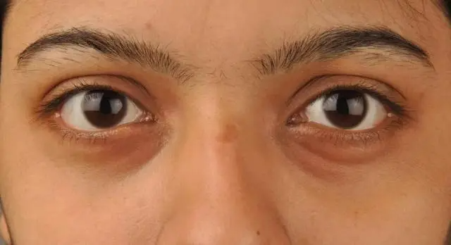 马应龙眼霜去眼袋有效吗