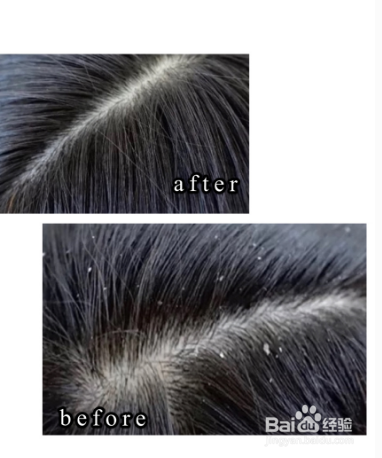 去屑小妙招有哪些?3个去屑小妙招试试看