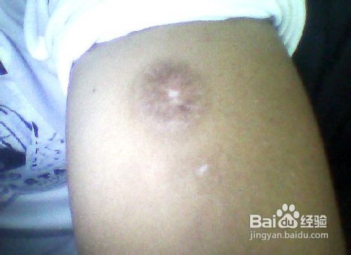 教你如何去除烟疤