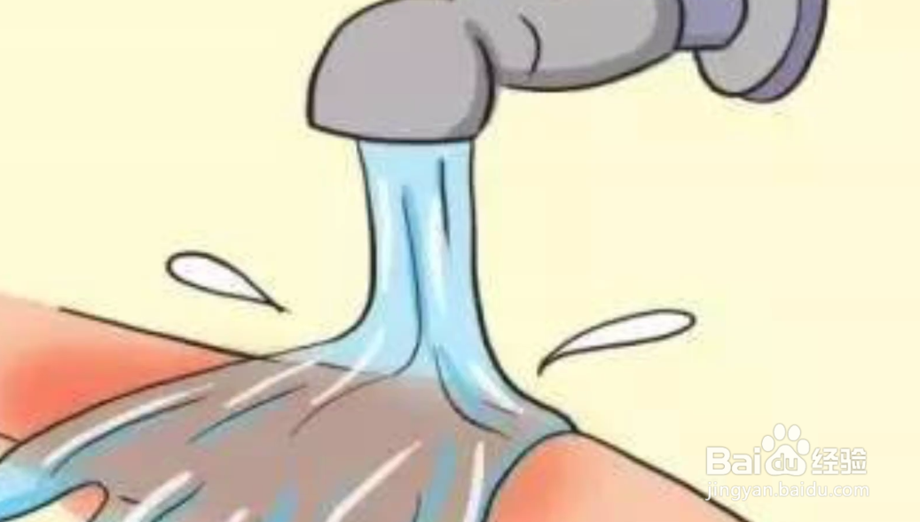 烫伤我们该如何处理?