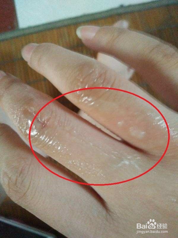 烫伤擦牙膏危害更大止痛之前这一步要做好