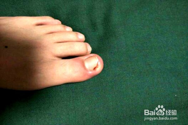 使用红外线灯可以治疗哪些疾病？