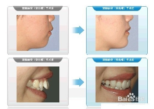 牙齿矫正什么时候好