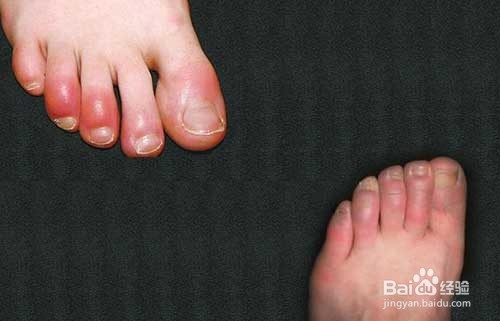 怎样治疗脚部冻疮