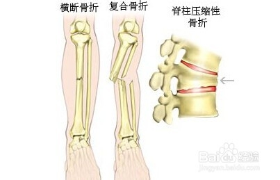 野外受伤应急救治六法。