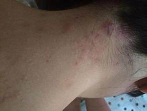 脖子上长湿疹的怎么办 百度经验