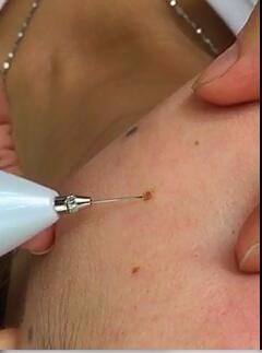 点痣笔的操作方法