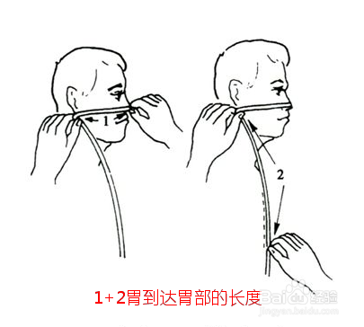 插胃管时测量长度的正确方法