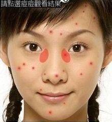 青春期如何告别战痘