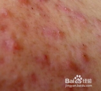 脸上起脓包怎么处理？能挤吗？